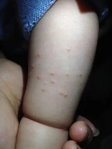 小孩四个月大,最近身上张类似小水泡的东西,上个星期胳膊张了几个已经