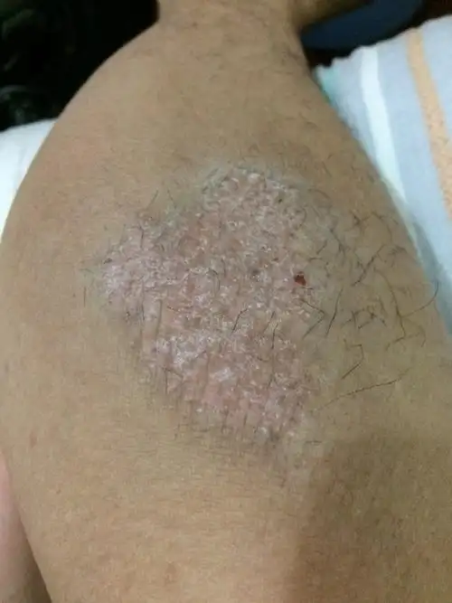 请问这是什么癣?身上就腿上这一块,好多年了