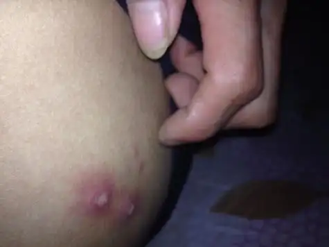 一个星期左右屁股起了几个这样的疙瘩不