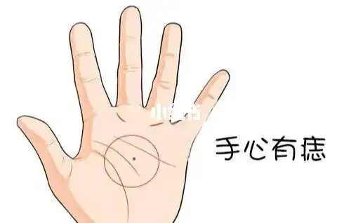 男人手心长痣好不好?