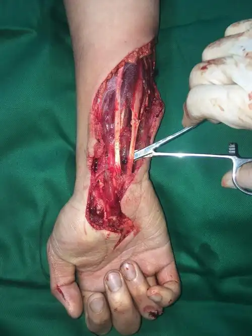 骨伤科 前臂切割伤手术1例