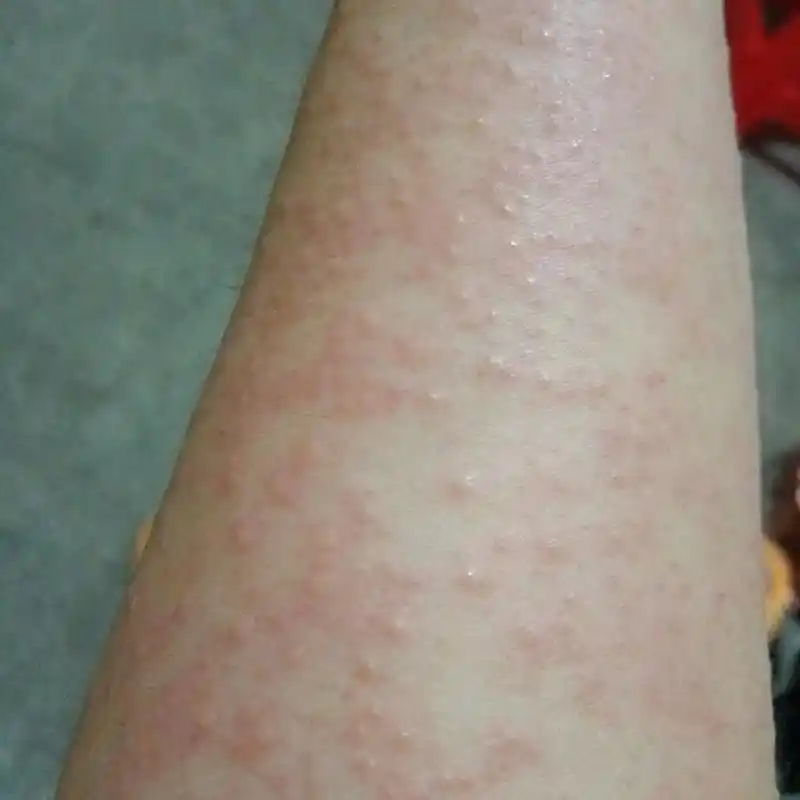 这双手啊 无法了 皮肤过敏 痒得无法入睡 - 抖音