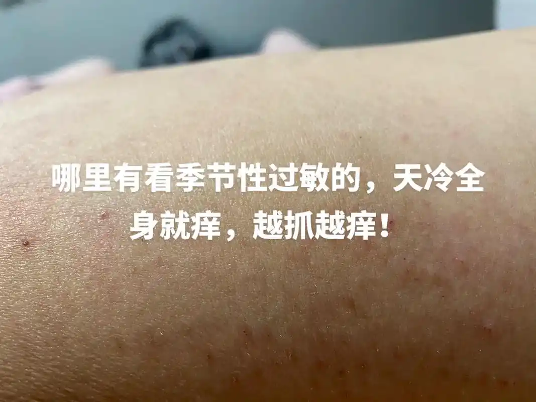 哪里有看皮肤过敏的,季节性过敏,天冷全身就痒,特别的晚上,越 - 抖音
