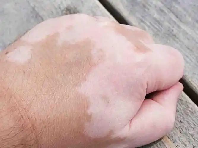 处于早期的白癜风症状图片