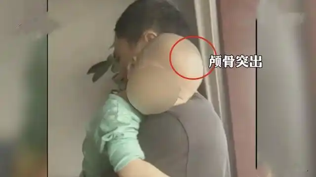 大头娃娃再现郴州多名婴儿诊断出佝偻病母婴店将饮料当奶粉推销