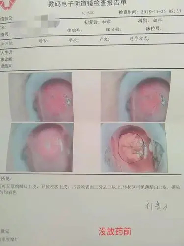 宫颈糜烂经针灸,外用药综合治疗重度变轻度