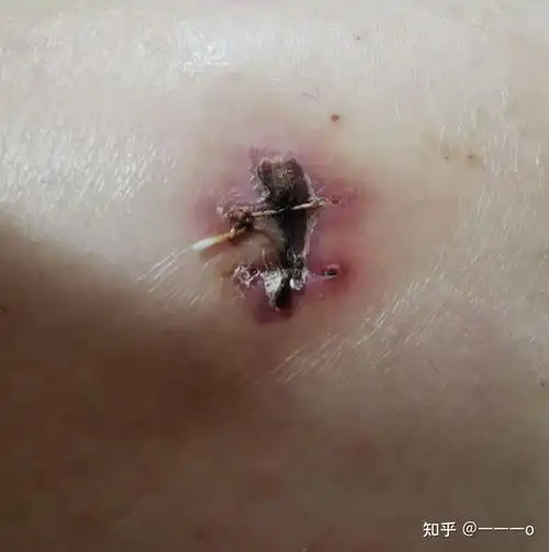 持续记录缝针后的恢复和祛疤过程