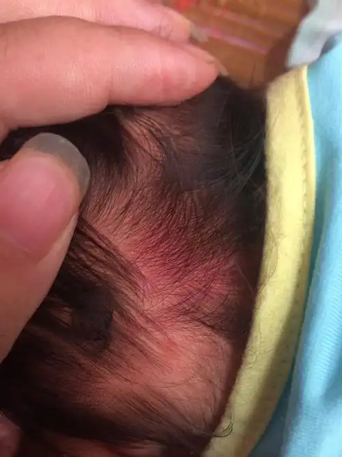 宝宝后脑勺处一块红红的是什么原因?