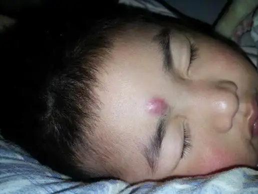 医生请问宝宝头上长的是硬疥疮吗按压有痛感医院医生