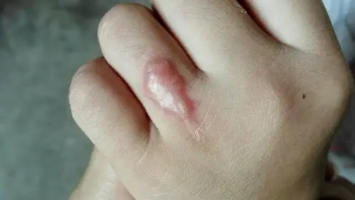 小孩子手上被烧溶的一次性杯子烫伤留下的伤疤怎么治疗