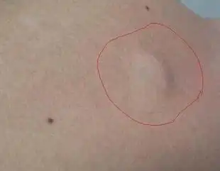 舌,唇,口底,鲜红或紫红色斑块4,皮下纤维瘤摸起来与别处皮肤明显不同