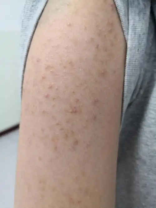 考虑马拉色菌毛囊炎症状可以使用药物抗真菌治疗#马拉色菌毛囊炎