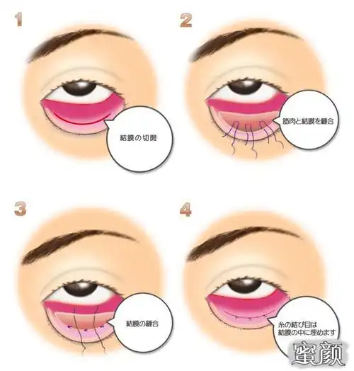 「眼睑下至」手术详解|医美整形-爱美美容优惠