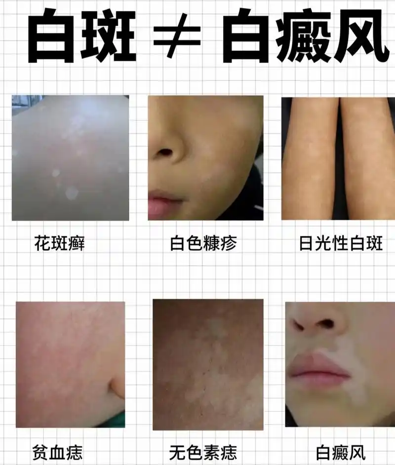 那怎么区分是不是白癜风呢?