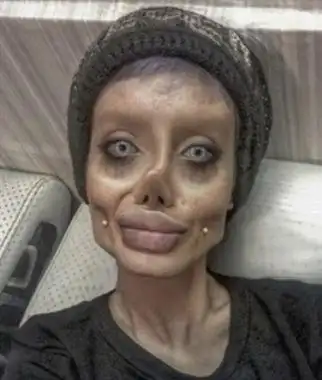 2亿前后整容50次,结果整成了丧尸!