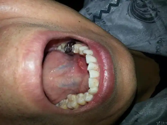 【专题讨论】发现左侧侧舌缘部溃疡 考虑什么 [病例帖]