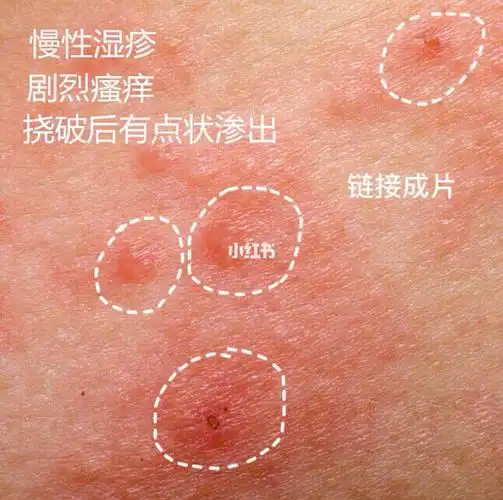 过敏,一次少量擦慢慢过渡96本人留美女博士95一枚,敏感肌,5年湿疹