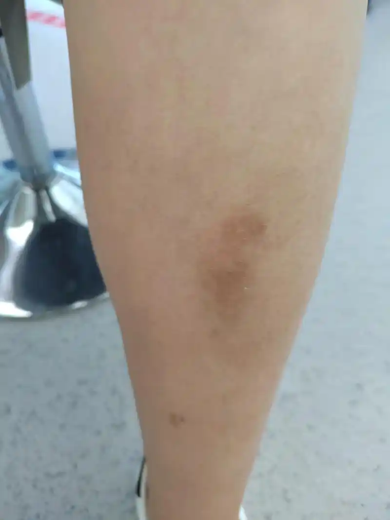 小腿胫前的色素沉着过度和皮肤粗糙症状.考虑淤积性皮炎可能.