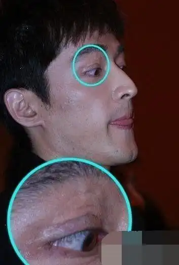 明星不承认整容, 这些疤痕怎么解释?