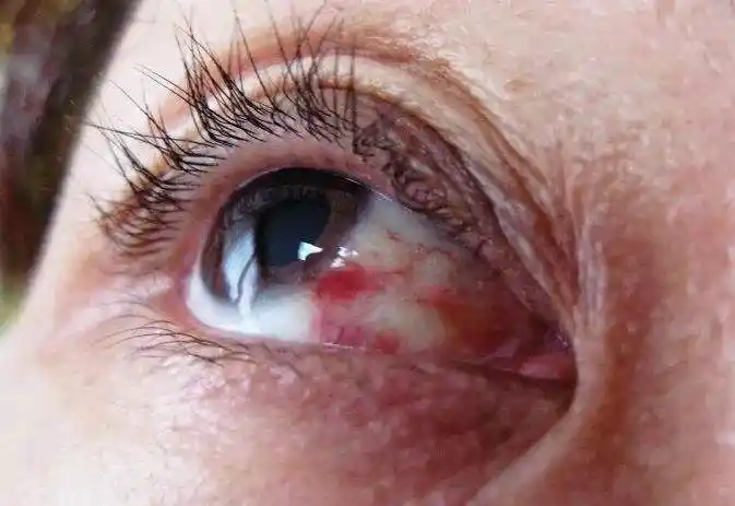 眼睛红(眼睛红血丝是大病前兆)