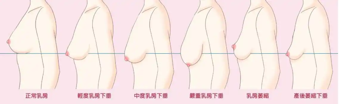 关于乳房下垂,相信很多女性朋友都比较关心这一类问题,因为乳房下垂