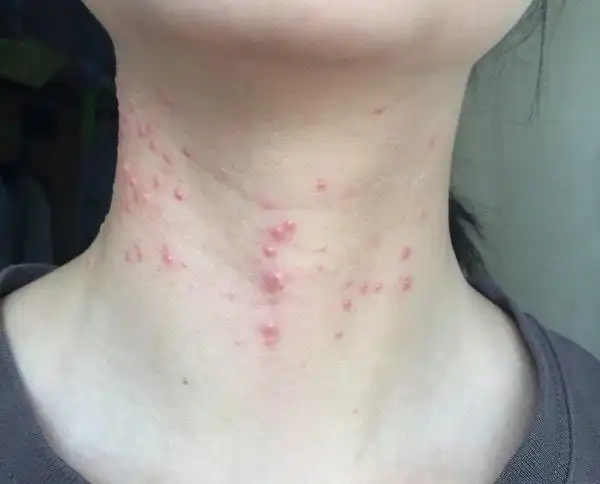 原创超拼健康助手丨脖子上长痘痘是什么原因这5点第一个你常做