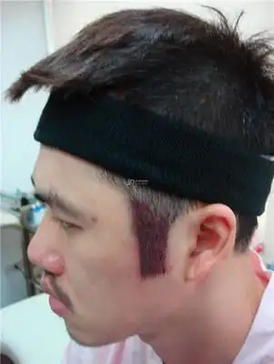 鬓角植发技术特别好