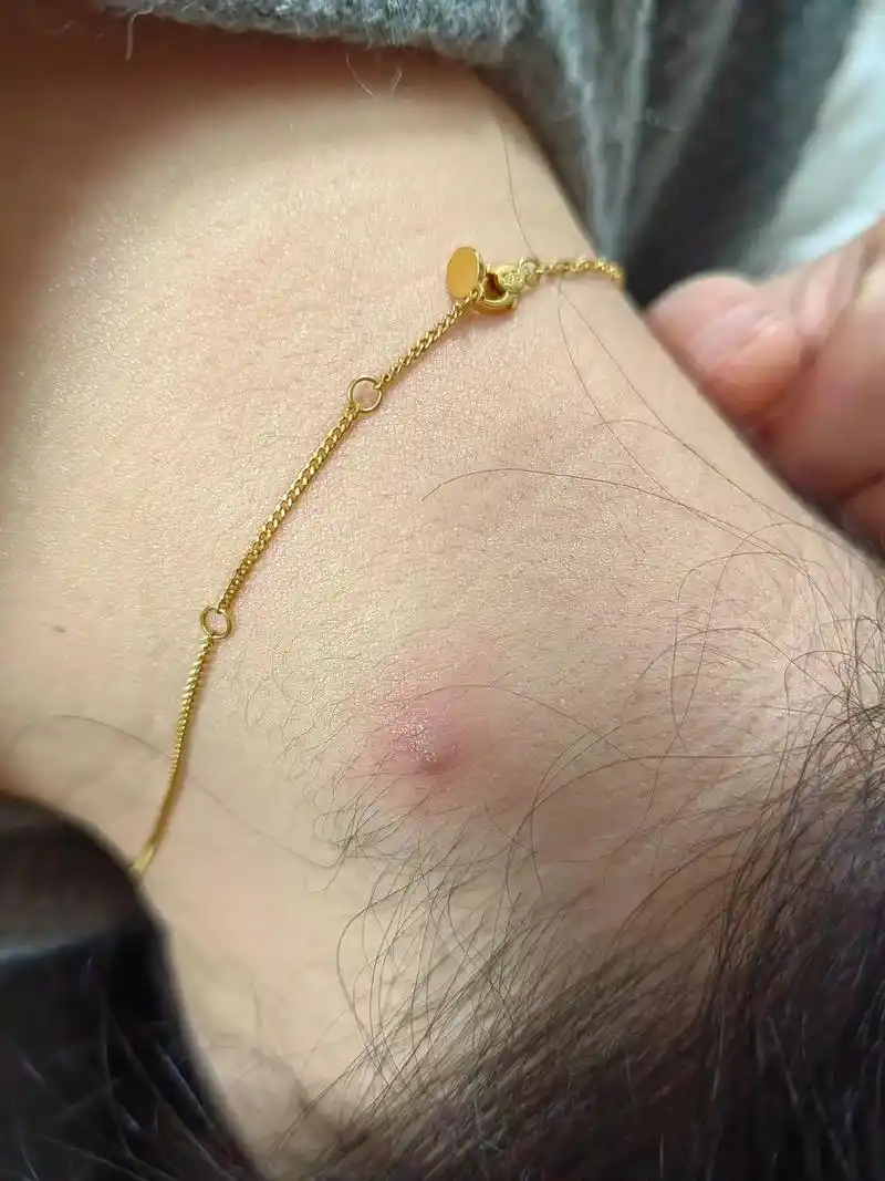 火疖子自愈过程 看着中间那几张我自己都看着恶心 一切都在往 - 抖音