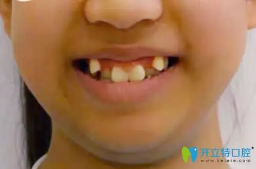 虎牙_虎牙价格_虎牙矫正_虎牙矫正的方法_虎牙能拔吗 - 开立特口腔