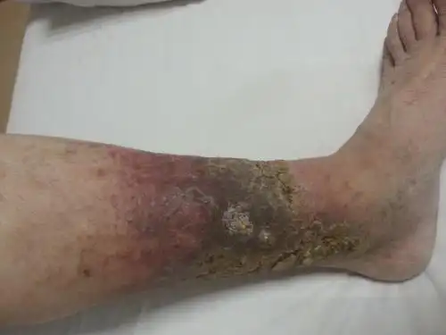 手术前,小腿皮肤发黑,有多处破溃