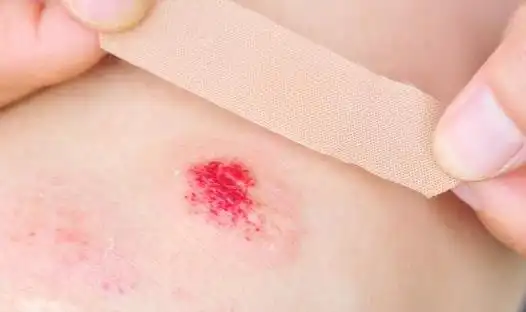 生活百科小妙招:日常处理小伤口的正确步骤 科学处理伤口的原则