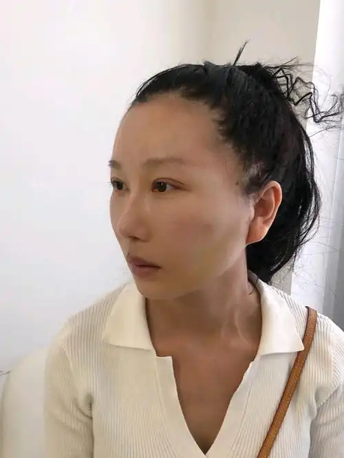 小切口拉皮人中缩短术后1周