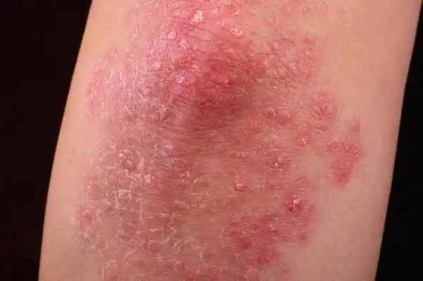 轻微牛皮癣症状图片_银屑病求医网