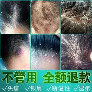 【头皮真菌感染药膏】头皮真菌感染药膏品牌,价格 - 阿里巴巴