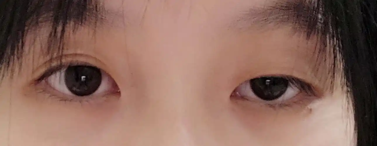 上眼睑肌无力下垂终于做决定去做了