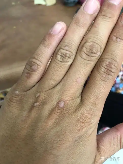 终于可以大声的说声我的扁平疣痊愈了