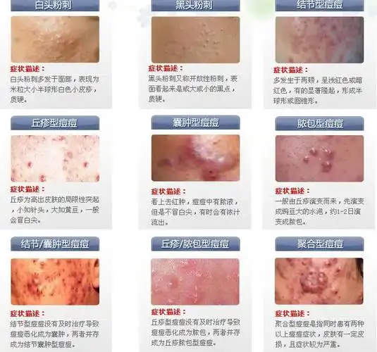 【健康常识】脂溢性皮炎经典问答30例