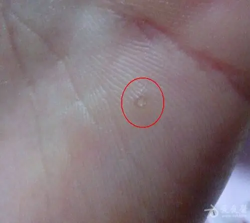 究竟是角化症,还是鹅掌风?