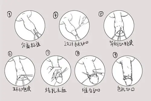 包皮手术流程