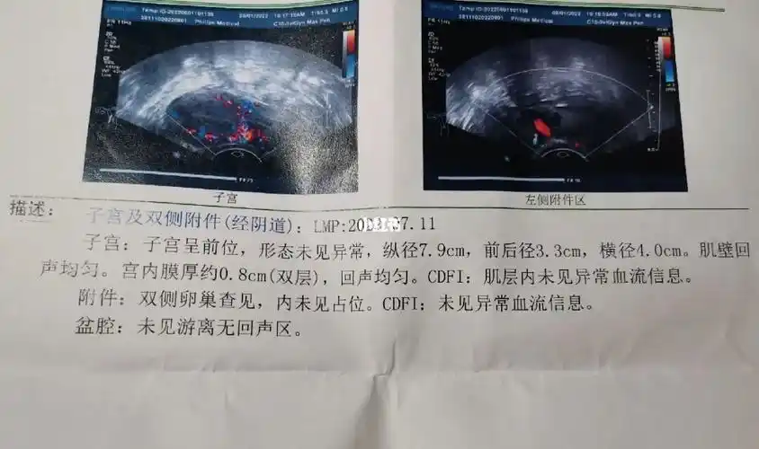 关于排卵期出血和黄体功能不足的经验分享