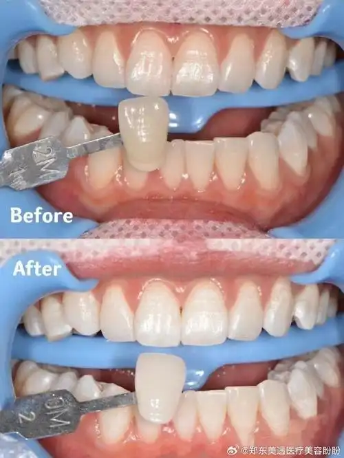 对比90价格68890#郑东美遇##郑东美遇医疗美容门诊部##美白牙齿