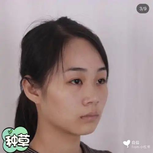 从小鼻子就不好看,鼻子太扁平了,毫无立体感,长大后_圈子-新氧美容