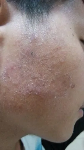 脸上长癣图片 (14)_有来医生