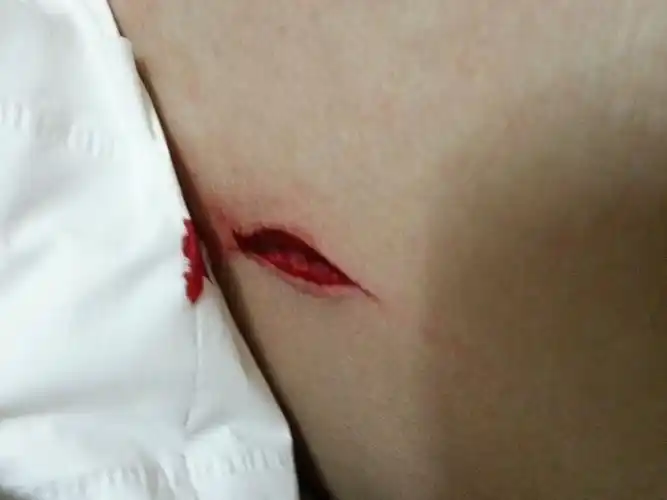 伤口要缝针么?求专业回答.