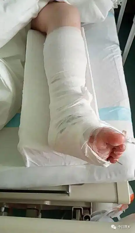 萍乡出了个小肖玉玲14岁女生李伊果勇救同学被压断腿