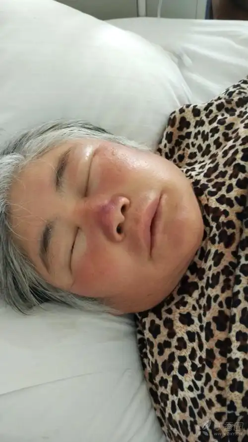 面部水肿大家帮忙看看 [病例帖]