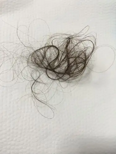 你们有谁像我这样掉头发掉得这么恐怖的啊?你们有什么治的办法啊?