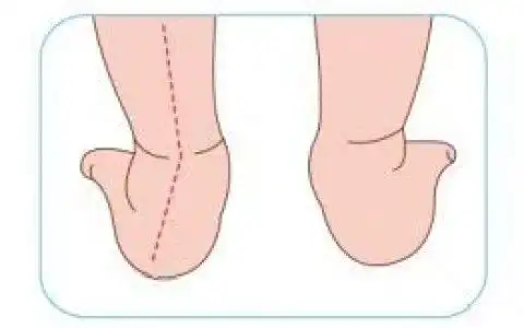 小孩走路内八字,走路内八字怎么校正