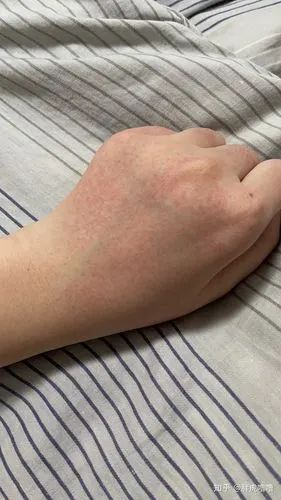 手背上突然起了一片小红点