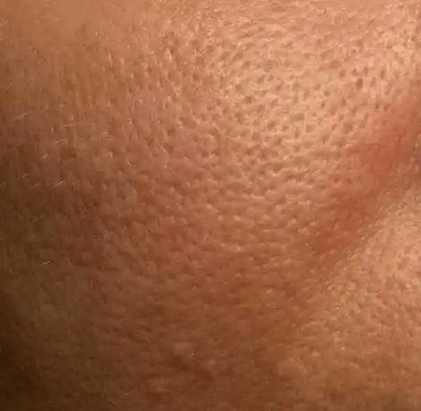 你的毛孔为什么变得粗大